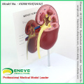 VENDER 12432 Modelo de anatomía del riñón enfermo de gran tamaño, 1 parte, corte, anatomía Modelos&gt; Modelos urinarios